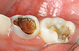 歯冠崩壊が大きく歯髄処置の必要な乳臼歯の画像
