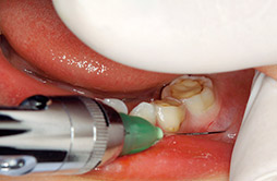 浸潤麻酔を根尖相当部の可動粘膜下に注入する画像