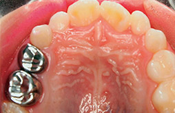 上顎左側乳臼歯に装着された乳歯冠の画像