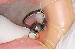 ラバーダム防湿下でキッズクラウン乳歯冠を試適しているの画像