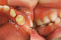 歯冠形成終了の咬合面観および頰側面観の画像