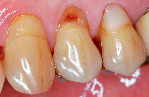 歯頸部う蝕：術前の写真