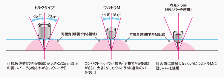 トルクタイプ/可視角（明視できる領域）が大きく20ｍｍ以上の長いバーでも軸ぶれがないウルトラE　ウルトラM/コンパクトヘッドで可視角（明視できる領域）がさらに大きくなったウルトラM（通常のバーを使用）　ウルトラM（短いバーを使用）/対合歯に接触しないようにウルトラMに短いバーを使用