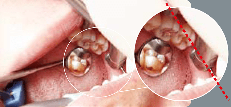 ウルトラM（SAR-UMX）大臼歯、智歯、開口の小さい患者さん等のアクセスしにくい部位でも歯軸に垂直にバーをあてて動かすことができる。