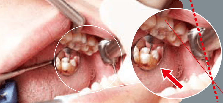 スタンダード（PAR-EX）大臼歯、智歯、開口の歯軸の側方からのアクセスになるため、ミラー位置がヘッドの側方になり、水滴がかかりやすい。またバーを倒して治療を行うため、余分に切削することがある。