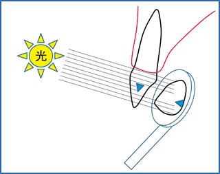 透過光線を用いた前歯隣接面う蝕の診査法（透照診）の模式図