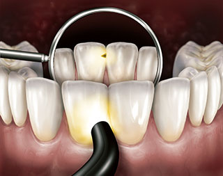 本製品を用いた前歯部の透照診の画像