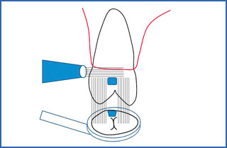本製品を用いた臼歯部の透照診の模式図