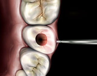 応用例：歯根破折の発見の写真