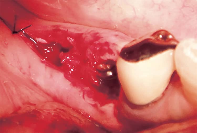 インプラント周囲に移植された骨。
