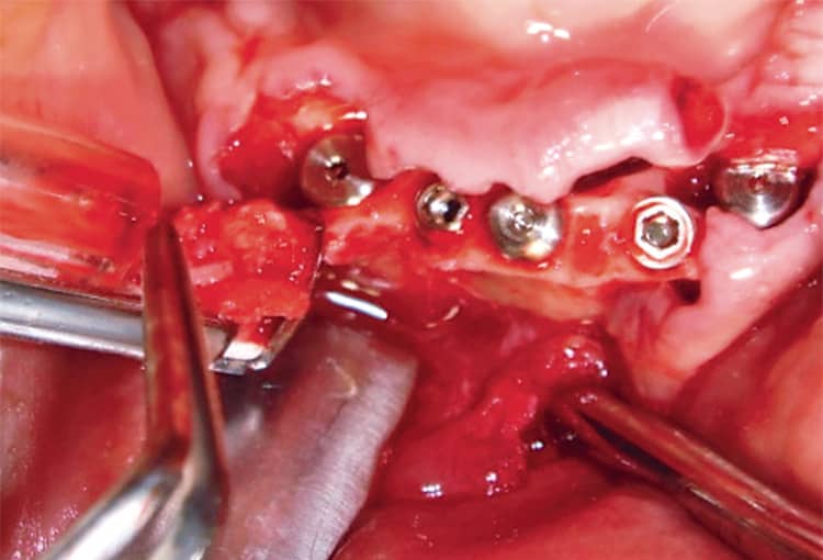 インプラントが埋入された。右側犬歯部にはインプラント体と歯槽骨に隙間がみられる。