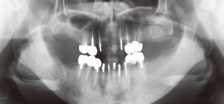 上下、左右全ての大臼歯部欠損。 ※2007年の症例であるため、この時点では当医院ではＣＴは未導入。