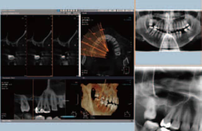 左：術前ＣＴ　右上：術前パノラマX‑P　右下：術部拡大。