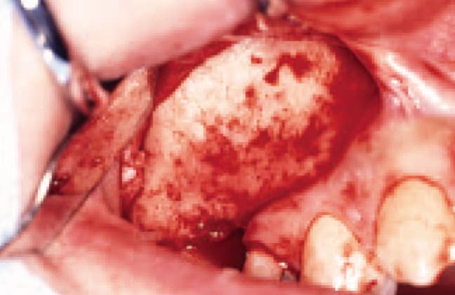 歯肉剥離、骨の露出。