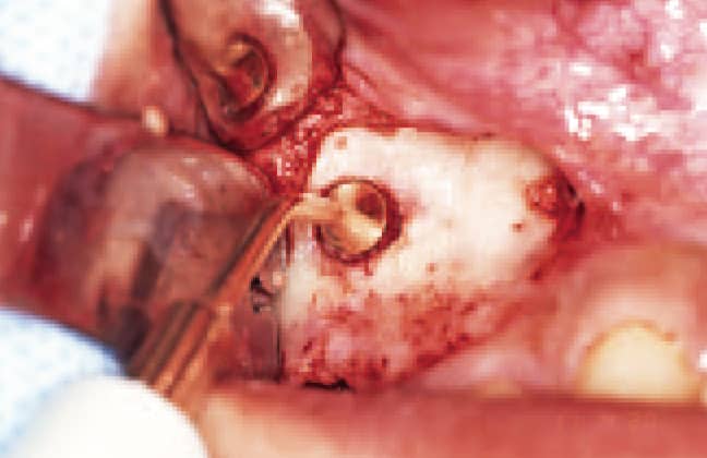 開窓部の大きさの確認。最初の必要開窓径はDM3‑003の径よりも僅かに大きい程度で十分である。