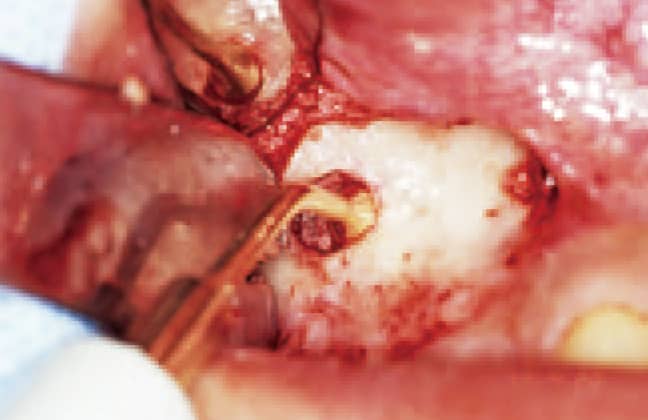 超音波振動にて開窓辺縁周囲の洞粘膜剥離を行う（DM3‑003を使用）。