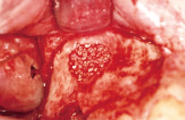 洞内に骨補塡を行う（今回は採取した自家骨とβTCP、HAをMIX）。