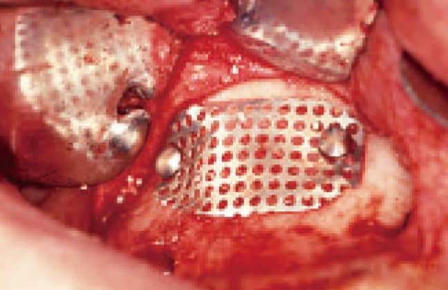 開窓部閉鎖のための骨片は、骨削片として補塡材に使用したため、チタンメッシュにて開窓部の閉鎖（この症例は後日インプラント埋入を行う2回法であるが、インプラントの同時埋入を行う1回法の場合は吸収性メンブレンを使用する）。