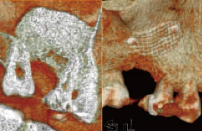 術後の3Dイメージ像。左：断面図　右：術後骨外観図