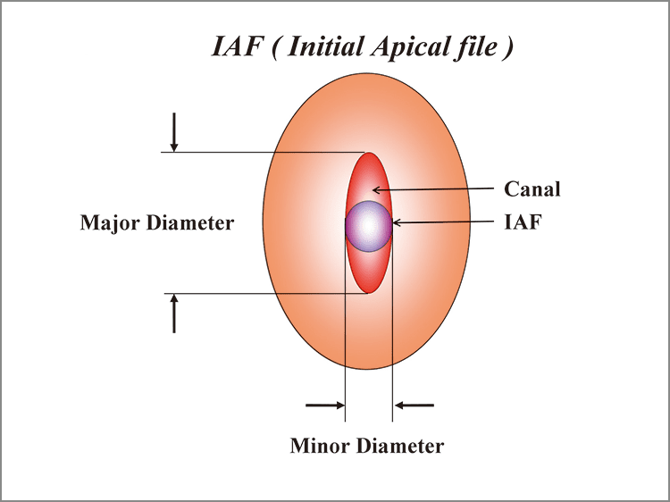 IAF ( Initial Apical file )