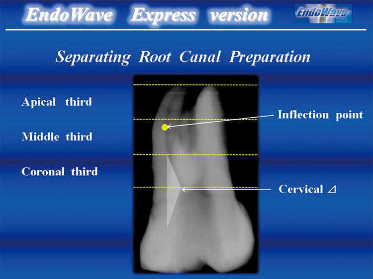 “Separating Root Canal Preparation” 根管を3パートに分けて形成を行うことにより、ファイルの破折、根管軸を維持する。