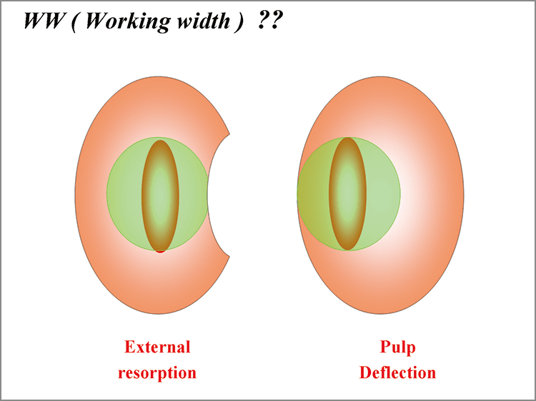 External resorption / Pulp deflection 歯根の外部吸収、歯髄の偏位が認められる症例では、根管に対して相似形の形成がより重要になる。