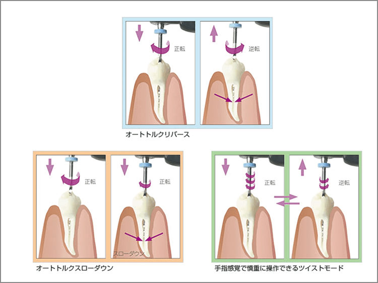 オ－トコントロ－ル機能 回転方向、トルクを任意に設定可能であり、ニッケルチタンファイルへの過度な負荷を防止し、ファイル破折の可能性を低減させた。