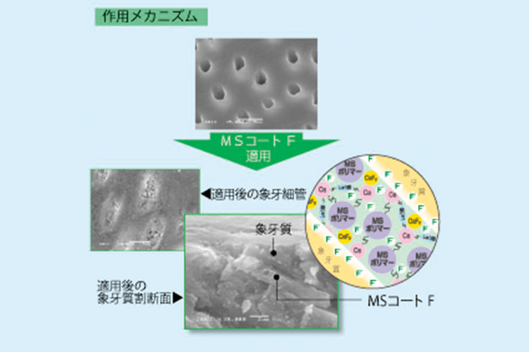 MSコート Fの象牙質知覚過敏抑制のメカニズムと象牙細管封鎖写真。