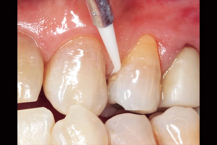 細くて適度な硬さのフェルトチップは、歯肉縁下にも適応する。