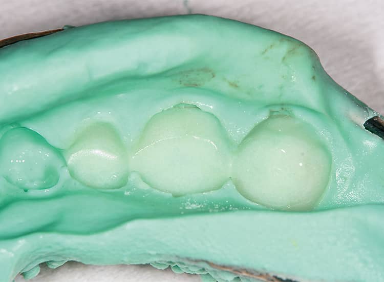 レジンを追加築盛し支台歯に圧接する。先に築盛した外層のレジンは既に硬化している。