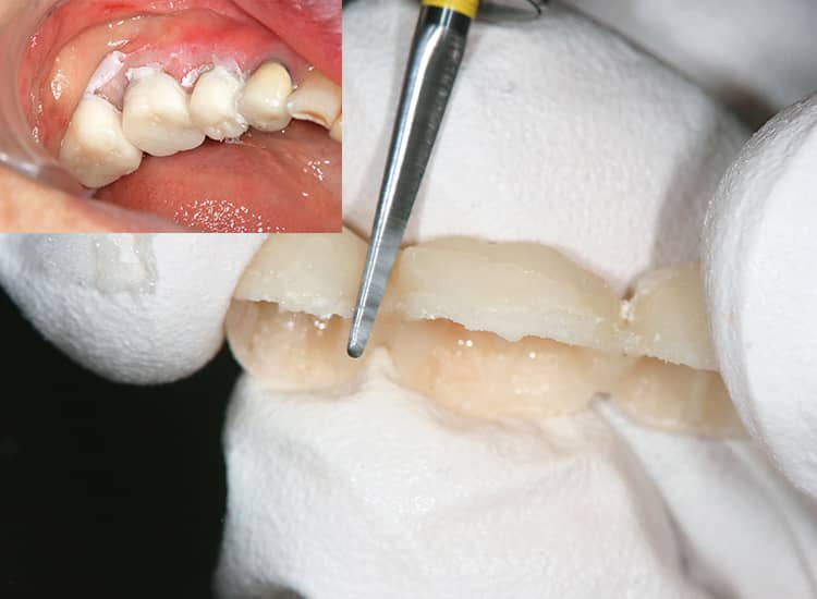 内側はゴム状なので支台歯に圧接して対合歯と咬合できる。硬化を待ってトリミングを行う。反応性有機質複合フィラー配合により、軽快に切削・研磨が可能。