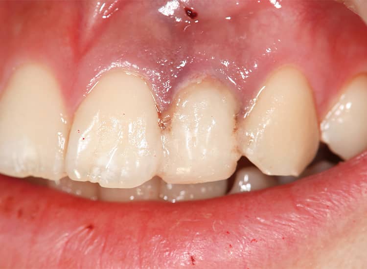 暫間の審美回復として、スーパーボンドでアクリルレジン歯を両隣在歯に固定した。