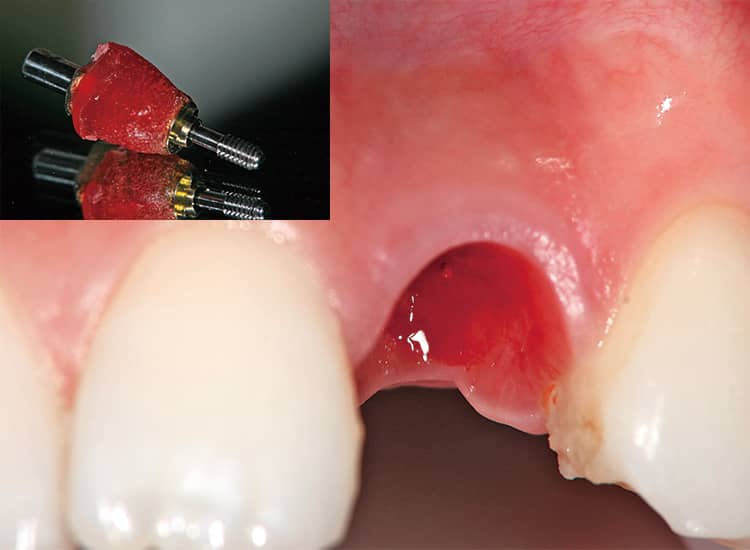 炎症なくスカルプティングされた歯肉の状態をカスタムインプレッションコーピングで正確に印象採得する。