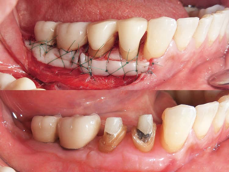 歯冠長延長術と遊離歯肉移植術を同時に行った例。このケースでは新たに2mmの歯肉縁上歯質と質の高い歯周環境を獲得できた。