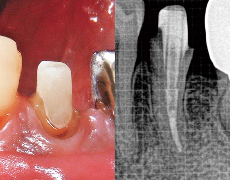 形成後の状態とレントゲン写真。高い適合状態が確認できる。