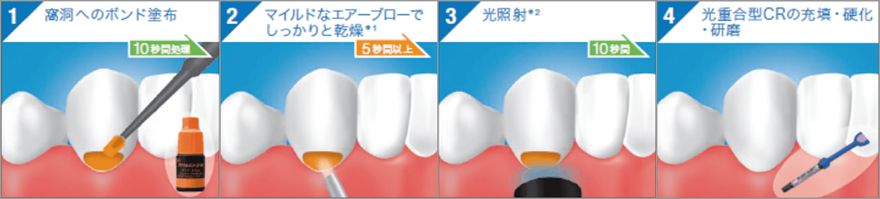 図15 ボンド SE ONEを用いたコンポジットレジン修復時の操作ステップ