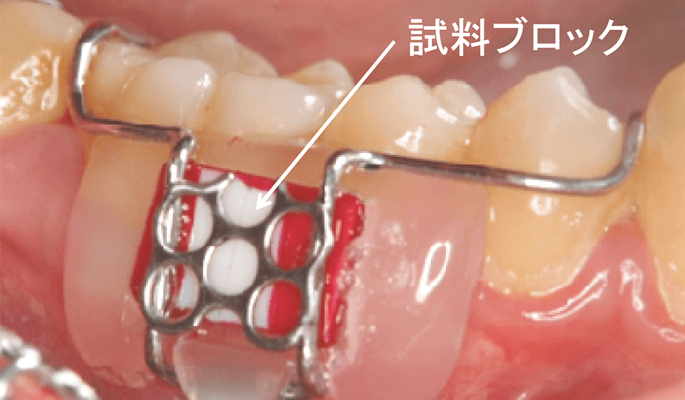 図7 口腔内に装着された装置