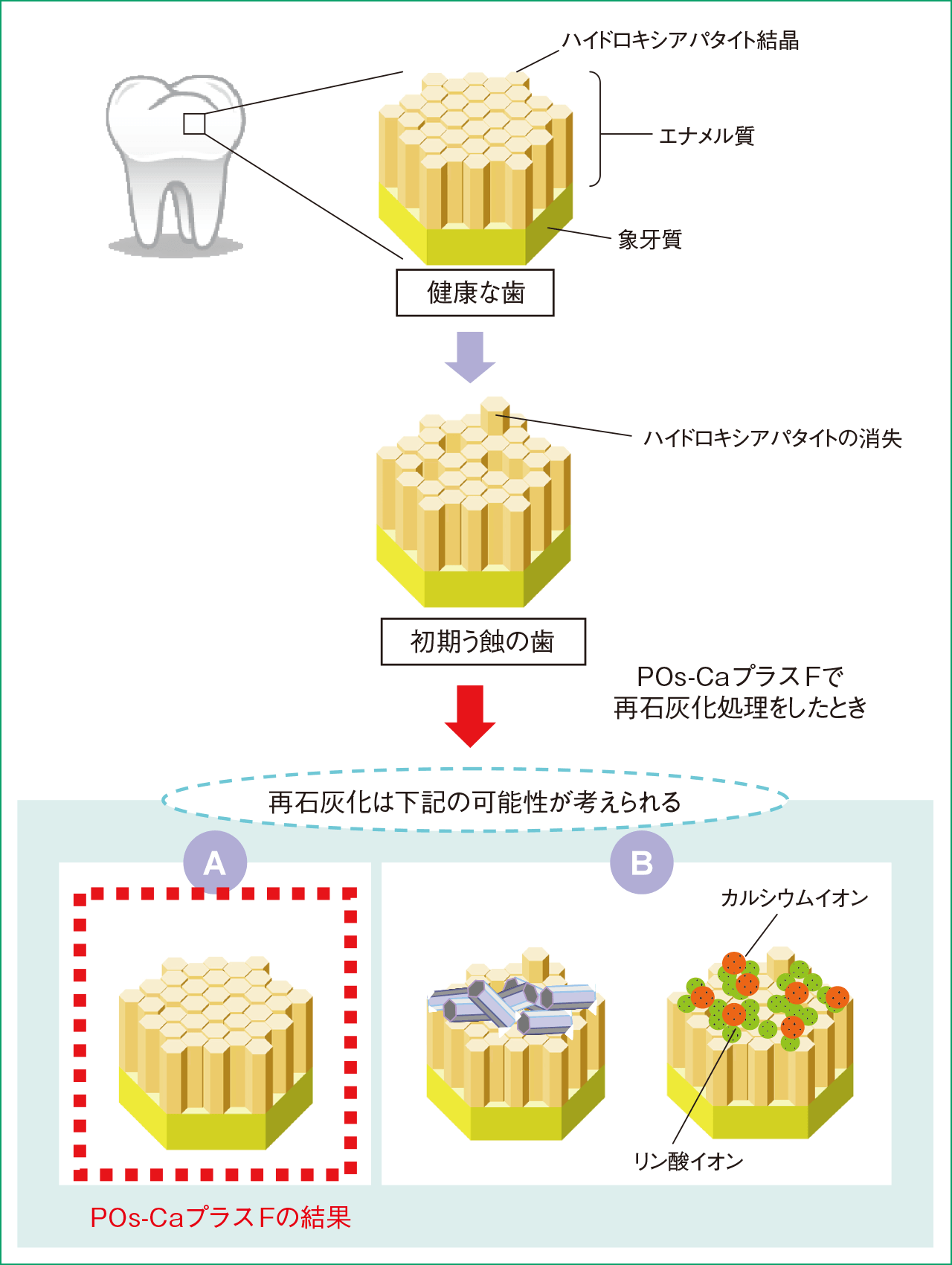 図13 POs‑CaプラスF ガムによるエナメル質初期う蝕の再石灰化の概念図ハイドロキシアパタイト結晶が、歯質の結晶と同じ方向性をもって配列する