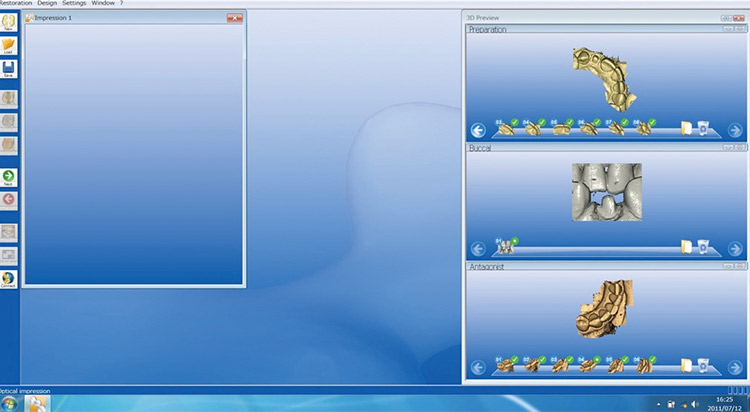 図5 光学印象画面。右上から形成歯列、中央はバッカルショットによるバイト、対合歯列。それぞれを3Dモデルで三次元的に確認可能。