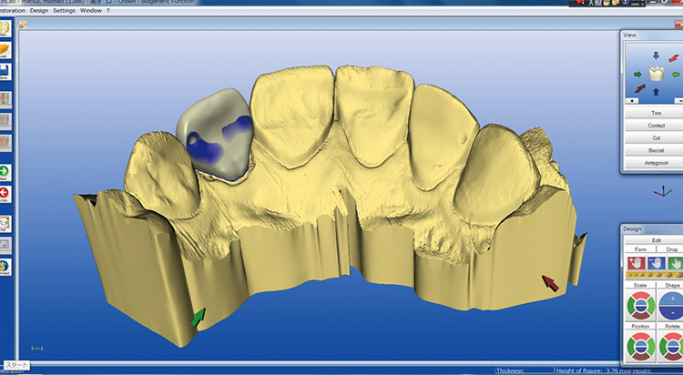 図9 初期提案画面2。舌側面観であるが遠心側のくぼみに注目。反対側同名歯の特徴を忠実に再現している。