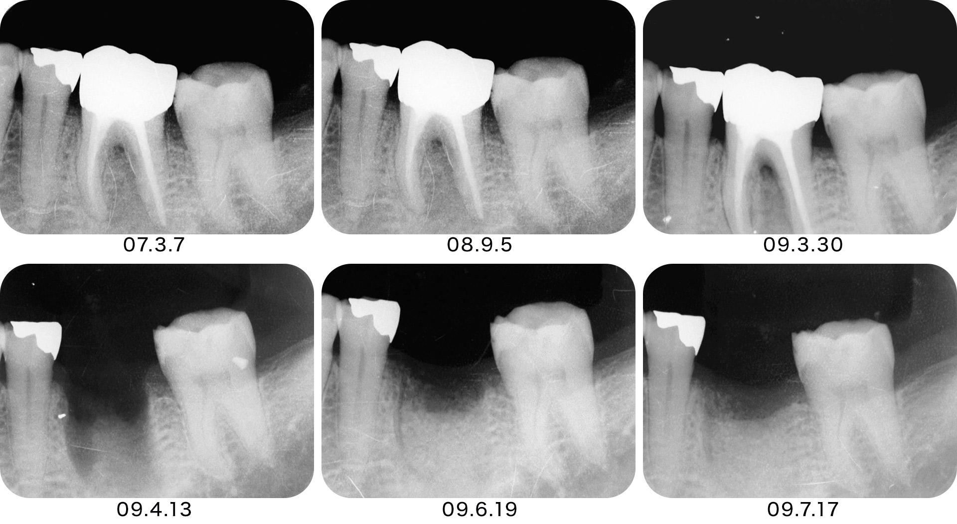 インプラント処置として即時埋入を行うのか待時埋入を行うのかということも重要な診断となる。特に複根管の場合は抜歯窩の状態をよく考慮する必要がある。
