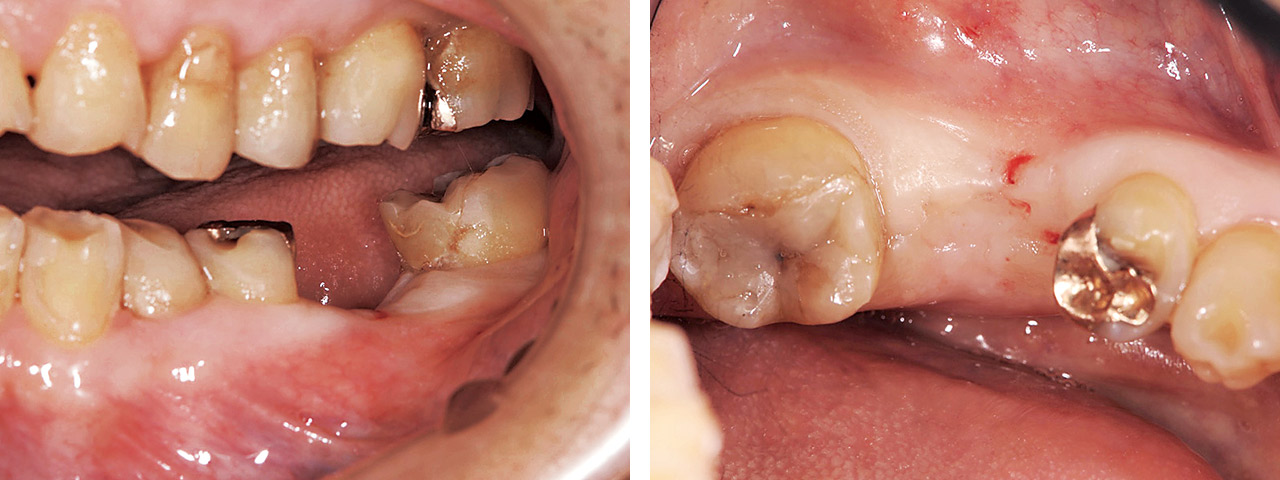 70歳男性、左下第一大臼歯の歯根破折により抜歯となる。1本義歯かブリッジかインプラントの選択が必要である。