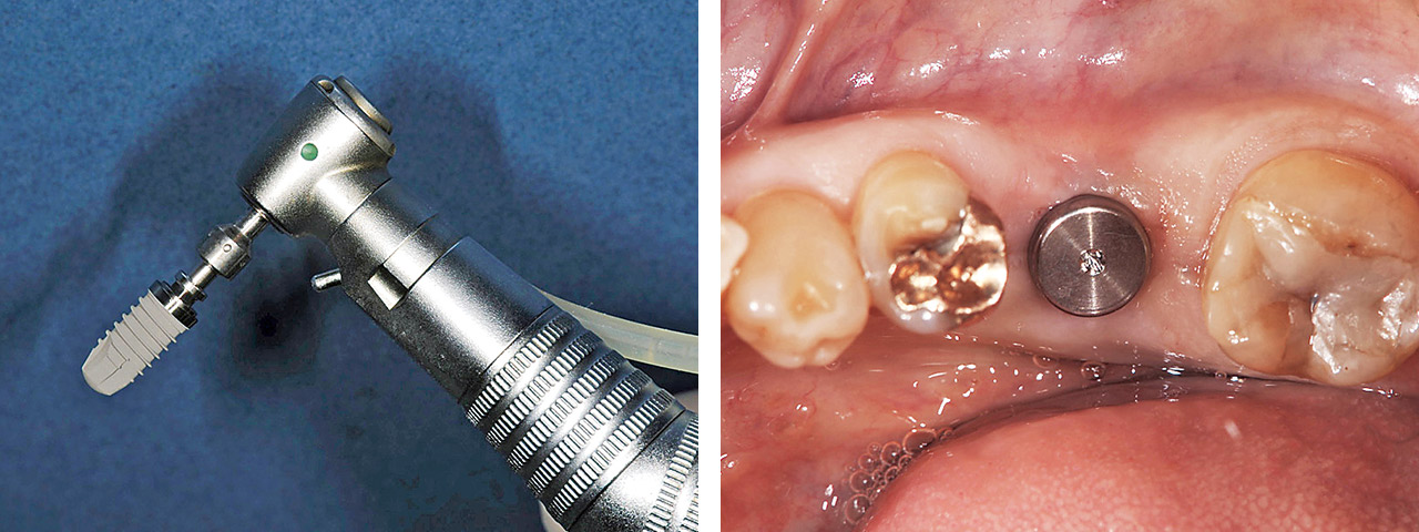 抜歯後4ヵ月待ってSPI インプラントを埋入。前後の歯の条件を考慮して欠損部には単独のインプラントを埋入した。抜歯後の治癒は順調であり、頰側の骨吸収も正常範囲内である。
