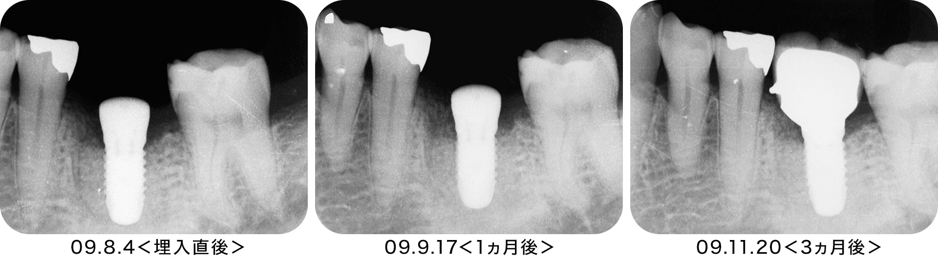 術後のデンタルX線。