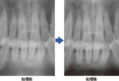 パノラマ可変断層の効果