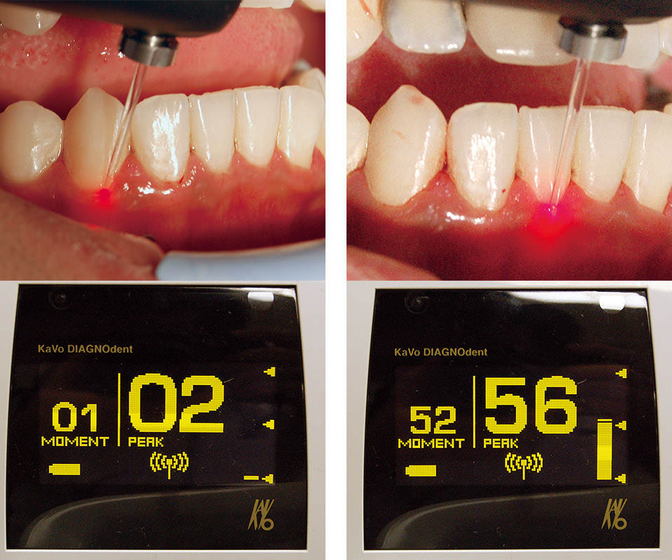 図9b ペリオプローブを用い、周囲の部位も含め測定したが、右下３番では02（左）、２番では56のピーク値を示した（右）。