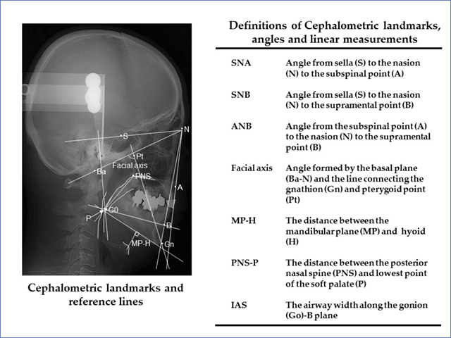 側方頭部X線規格写真（側方セファロ）の計測点と計測角および距離についての写真