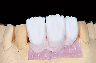 歯肉色陶材（Tissue6）の築盛の写真