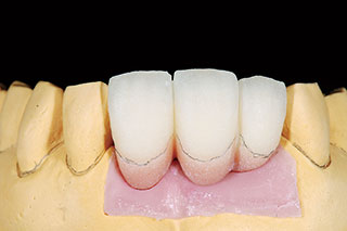 歯冠部形態調整の写真