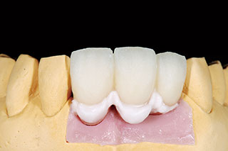 歯肉色陶材・角化歯肉部の調整（Tissue 1）の写真